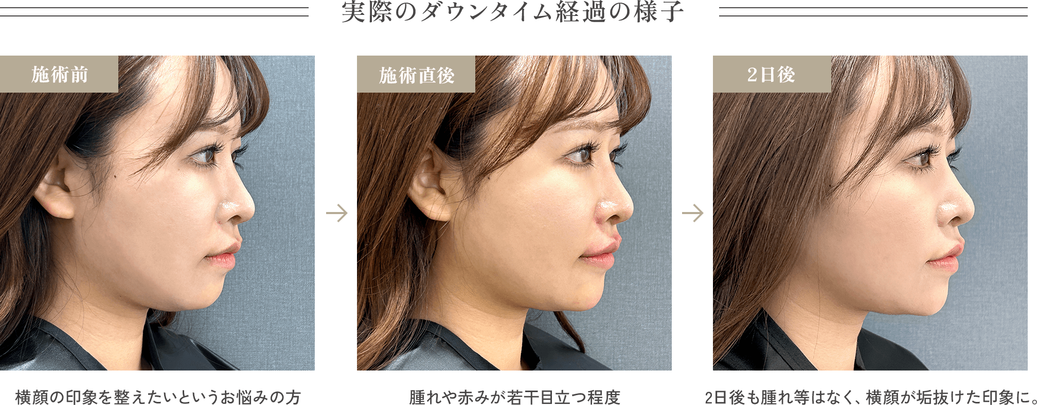 実際のダウンタイム経過の様子