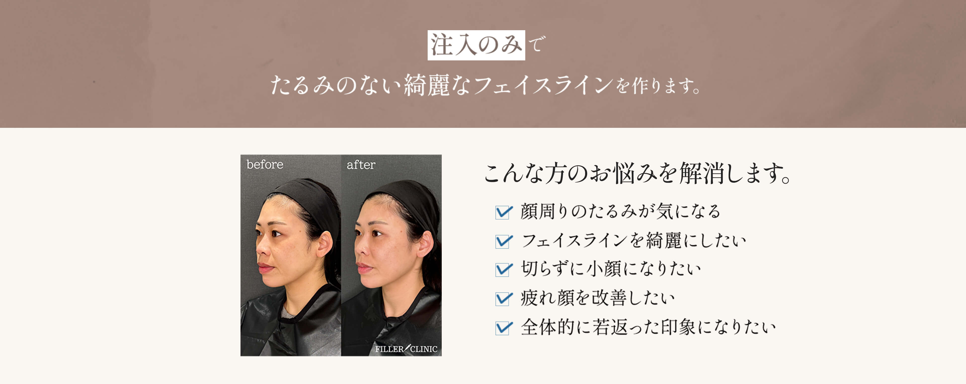 注入のみでたるみのない綺麗なフェイスラインを作ります。